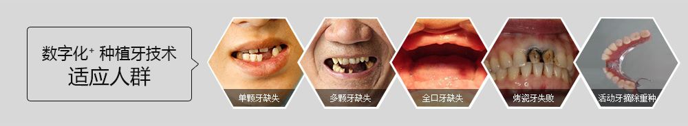 數字化種植技術適應人群